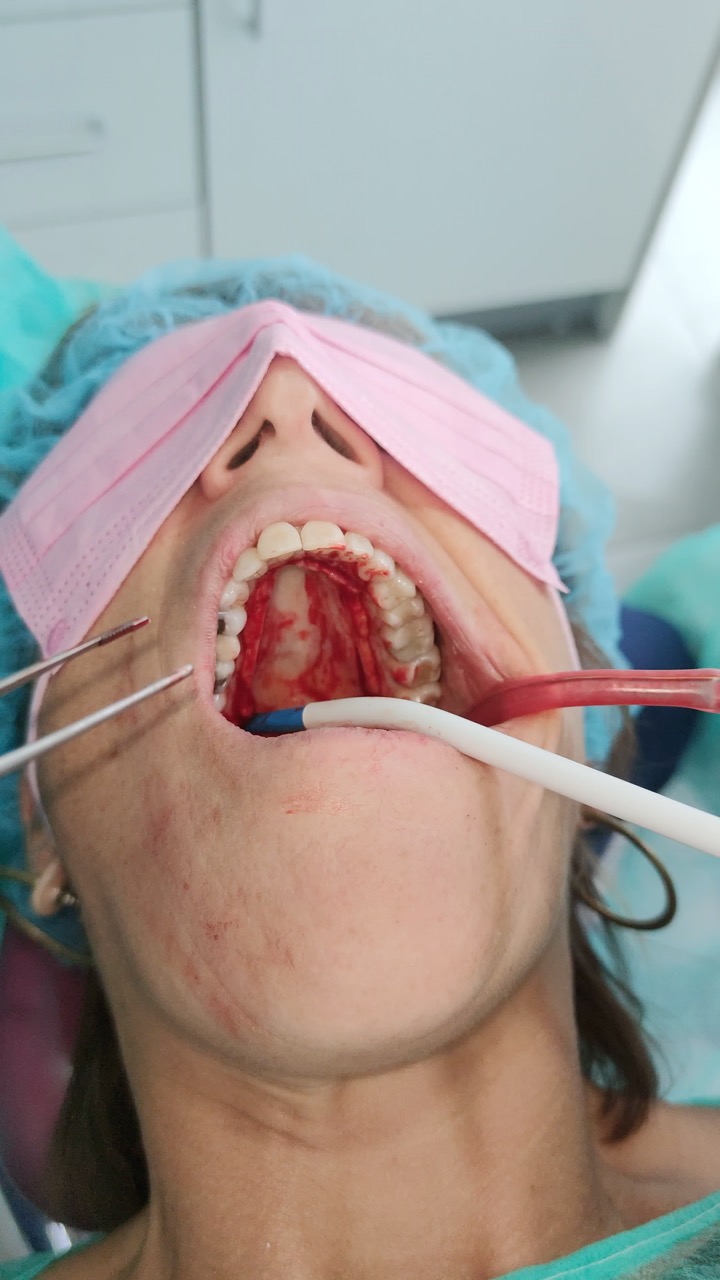 Curso de regeneración ósea guiada